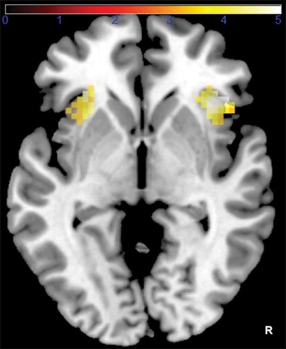 Figure 1. Shows an axial slice through the bilateral fronto-insular clusters of activation for the contrast of work: Personal focus vs. Work: Task focus