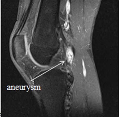 Figure 3 The left knee sagittal T1 with contrast MRI; aneurysm formation caused by the compressed popliteal artery can be observed at the popliteal artery.