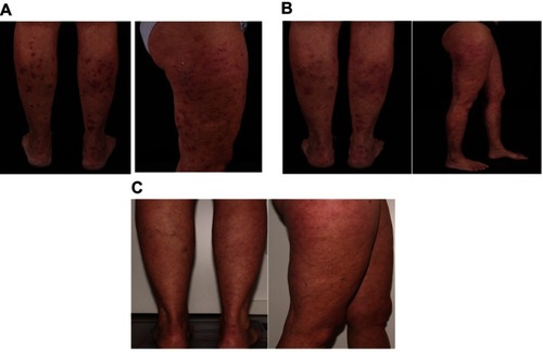 Figure 3 Case 2: psoriatic lesions on the back of the lower legs and the right upper leg (A) before and (B) after 6 weeks on brodalumab, and on the back of the lower legs and right upper leg (C) after 32 weeks on brodalumab.