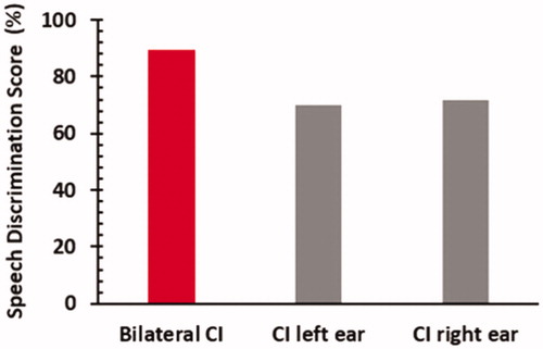 Figure 14. Mean of monosyllabic word discrimination scores tested in quiet with both CIs, as well as with the right CI and left CI separately. Statistical analysis: Wilcoxon test and paired t-test. Histogram created from data given in Kühn-Inacker et al. [].