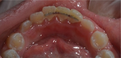 Figure 8 Lingual view showing the retainer in place. Some plaque accumulation noticed.