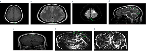 Figure 2 (a) Axial T1WI-SE brain MRI shows slightly high signal intensity of superior sagittal sinus posteriorly (arrow) compared to cerebral white matter. (b) and (c) Axial T2-weighted and Diffusion-weighted Imaging (DWI) Brain MRI depicting high signal intensity along the posterior aspect of the superior sagittal sinus (indicated by arrows) respectively. (d) and (e) Sagittal T2-weighted spin echo (T2WI- SE) and coronal T1-weighted spin echo (T1WI-SE) brain MRI demonstrating hyperintensity along the posterior aspect of the superior sagittal sinus and the right vein of Trolard (superior anastomotic vein) respectively. (f) and (g) The MRV reveals a focal absence of blood flow (filling defect) along the posterior portion of the superior sagittal sinus and the right vein of Trolard (superior anastomotic vein).