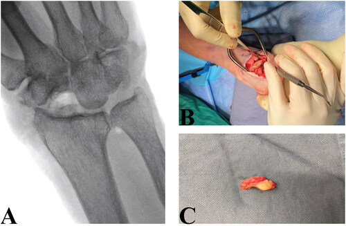 Figure 5. A: Postoperative radiograph of right wrist joint. B: Intraoperative image showing excision of proximal carpal bones. C: Scaphoid with flattened and collapsed proximal pole.
