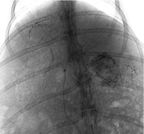 Figure 4 Embolization with magnetic particles and Lipiodol®, with the agent deposited well in the lesion, and quite a few particles seen in the normal hepatic parenchyma.