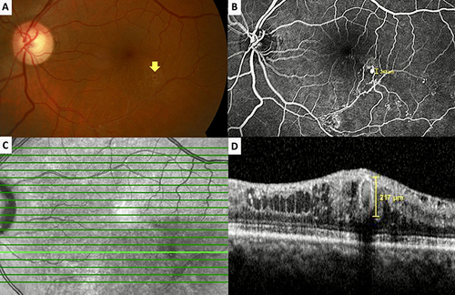 Figure 4 Case 13, Left eye of a 50-year-old woman with chronic lower branch vein occlusion. Color fundus picture (A) demonstrates the round, hyalinized-looking intraretinal macroaneurysm (IMA) (arrow) with a white rim located inferotemporal to the fovea. Mid-phase fluorescein angiogram (B) depicting a round, well-defined, hyperfluorescent IMA and areas of capillary drop-out. Reflectance image (C) showing the hyporeflectant well-defined round lesion. Horizontal spectral domain optical coherence tomographic section (D) passes through the IMA revealing the vertically oval hyperreflective lesion together with epiretinal membrane, intraretinal cystic spaces, and well-preserved outer retinal layers.