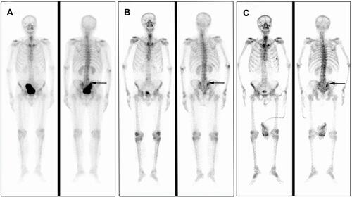 Figure 2 Imaging materials of the SPECT (black arrow indicates the right iliac bone). (A) At initial diagnosis, SPECT indicated that the tumor had metastasized to multiple bones including the right ilium and the right sacroiliac joint in April 2018. (B) Bicalutamide and goserelin greatly alleviated bone metastases in June 2019. (C) The SPECT in December 2019 indicated that the lesions on the right iliac bone and the right sacroiliac joint were relative stable. A new lesion could be found on the 5th left anterior rib, which was more likely caused by chronic trauma.
