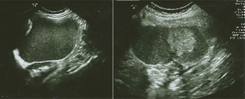 Figure 1 (Left): TAS at 20 weeks right adnexal mass with ground-glass appearance; (right): Solid component.