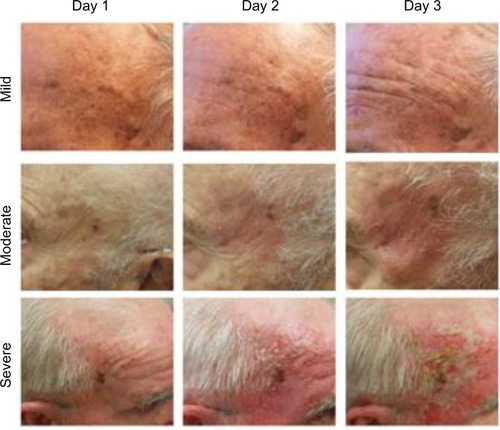 Figure 2 Clinical photographs of representative mild, moderate, and severe LSRs at days 1, 2, and 3 following ingenol mebutate treatment.