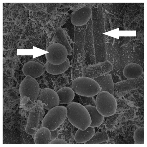 Figure 5 SEM of the contaminated OBC showing Candida albicans biofilm.