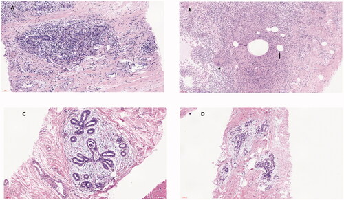 Figure 5. Pathological changes in IGM after ablation. Histopathological manifestations of IGM: (A) destruction of the normal lobular structure. (B) non-caseous granuloma, which is composed of lymphocytes, epithelioid tissue cells, and multinucleated giant cells surrounded by clustered neutrophils and confined to the lobules of the mammary gland. Microabscesses and lipid vacuoles are located at the center of the lobules. (C, D) IGM treated by MWA. The lobular structure damage is reduced. The number of inflammatory cells has decreased significantly, and the interfibrillar substance is mucinous.