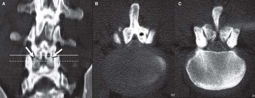 Figure 4. Contrast-enhanced spinal CT scan. A: Frontal plane reconstruction clearly demonstrated spondylolysis of the bilateral inferior articular processes of the L4 vertebra (arrows). B: Horizontal sections at L4/5 disc revealed sagittalization of the L4/5 facet, and deviation of the inferior articular processes of L4 to the right and anterior direction which compressed the dural sac. C: Horizontal sections at the superior margin of the L5 vertebra revealed bone fragments separated from the inferior articular processes of L4.