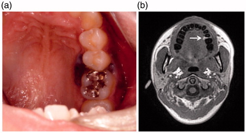 Figure 1. (a) Intraoral examination. A lobulated black bulging mass covered with squamous epithelium at the palatal aspect around left upper gingiva (5th–6th). (b) Magnetic resonance images (MRI). A bulging mass in the left upper gingiva, visualized as a hyperintensity on T1WI (both in-phase out-of-phase).
