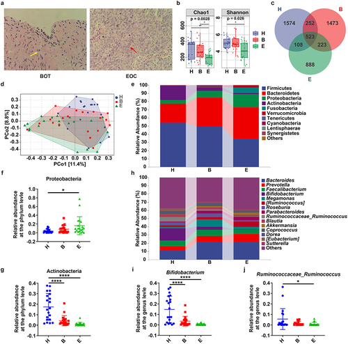 Figure 1. Gut microbiota (GM) Comparison between healthy controls, patients with epithelial benign ovarian tumor (EBOT) and epithelial ovarian cancer (EOC). (a) the typical pathological examination results of EBOT and EOC patients (10 × 40 magnification). The fibrous connective tissue was indicated by a yellow arrow, while the ovarian cancer cells were indicated by red arrow. (b) Comparison of alpha diversity indices (Chao1 and Shannon index) among three groups. (c) Venn map representation of amplicon sequence variants (ASVs). (d) principal coordinates analysis (PCoA) with Bray–Curtis distance of β diversity index. (e-g) Microbial composition at the phylum level. The relative abundances of Proteobacteria and Actinobacteria in three groups were analyzed. (h-j) Microbial composition at the genus level. The relative abundances of Bifidobacterium and Ruminococcaceae_ruminococcus in three groups were analyzed. H: healthy controls (n = 20); B: patients with EBOT (n = 20); E: patients with EOC (n = 20). Data are presented in means ± SD. One-way analysis of variance (ANOVA) with Tukey’s test for multiple comparisons. *P < 0.05, **P < 0.01, ****P < 0.0001.