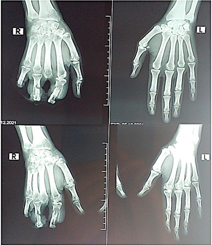 Figure 2 Bilateral hands x-ray demonstrating right hand reduced bone density in the distal end of radius and ulna, carpal bone, and metacarpophalangeal joint with a fracture in the index and ring fingers and amputated middle finger. Normal left hand.