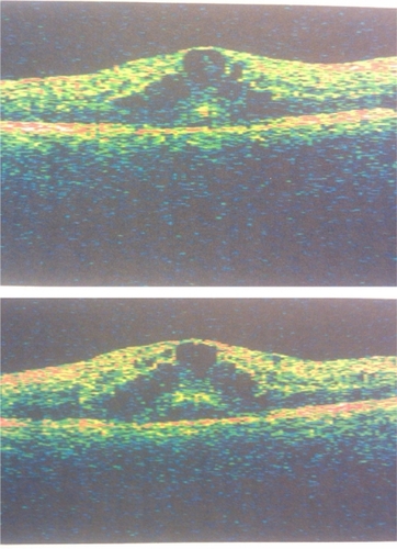 Figure 2 A) Optical coherence tomograph of macula at initial presentation, right eye. B) Optical coherence tomograph of macula at initial presentation, left eye.
