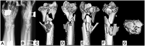 Figure 3. Plain x-ray and three-dimensional computed tomography of the right wrist after external fixation as a first-line treatment. (A,B) Plain x-ray of the right wrist; (C–G) 3-D CT of the right wrist.