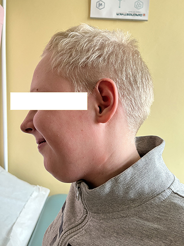 Figure 3 Photograph of the face of the patient with 2p15 microdeletion syndrome – side view. Note characteristic features: sloping forehead, full lips.