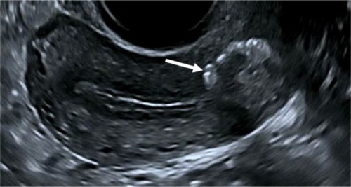 Figure 2 2D sagittal ultrasound of uterus with IUB (arrow) in lower uterine segment and upper part of the cervical canal.
