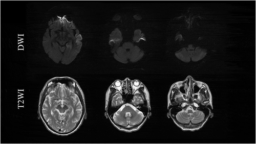 Figure 3. Magnetic resonance imaging findings in T2-weighted images (T2WI) and diffusion-weighted images (DWI) in the brainstem. Normal findings were observed.