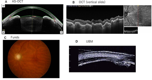 Figure 1 Patient 1’s AS-OCT, OCT, and Fundus results at 92 days after microhook surgery. (A) The AS-OCT revealed ciliary detachment on both the nasal and temporal sides. The temporal ciliary detachment was larger. The anterior chamber was very narrow. (B) The OCT sliced vertically on the macular area. Retinal folds were observed. (C) Fundus results: retinal folds due to low IOP were observed. (D) Ultrasound biomicroscopy (UMB) revealed ciliary detachment on both the nasal and temporal sides.