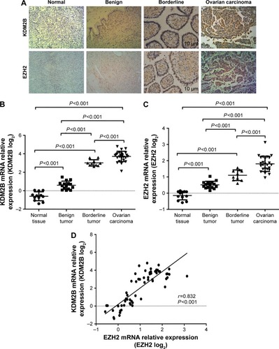 Figure 1 Expression of KDM2B and EZH2 in different ovarian tissue specimens. (A) KDM2B and EZH2 expression in the normal tissue, benign tumor, borderline tumor, and ovarian carcinoma (×200 magnification). (B) KDM2B mRNA relative levels in the normal tissue, benign tumor, borderline tumor, and ovarian carcinoma. (C) EZH2 mRNA relative levels in the normal tissue, benign tumor, borderline tumor, and ovarian carcinoma. (D) EZH2 expression was positively correlated to KDM2B (r=0.832, P<0.001).