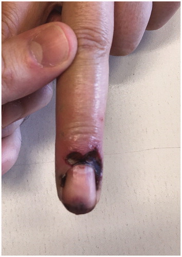 Figure 5. Skin with a hemorrhagic patch.