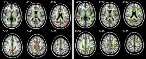 Figure 1 TBSS analysis of FA and RD volumes revealed lower FA values (in red-yellow) and higher RD values (in yellow) in anxious MDD group when compared with the nonanxious group.