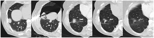 Figure 5. CT axial images. 71-year-old patient with colonic metastases evolving towards fibrosis.