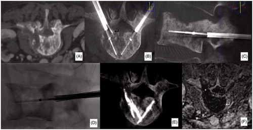 Figure 1. Case from authors’ personal series. Sixty-year-old man affected by a multi-metastatic lung cancer. The patient was referred for local treatment of a painful mixed metastasis of L3 (A). Bipolar RFA was performed with a bi-pedicular approach under CBCT-guidance (B–D). Ablation was conducted following the deployment of a thermometer at the level of the posterior wall to monitor temperature rise at this level (↵). Following RFA, due to the mixed aspect of the metastasis, the quantity of cement injected was minimal and limited to fill the bone trocars pathways. Contrast-enhancement MRI obtained 48 h following RFA shows a large necrotic area roughly reproducing the shape of the vertebral body (↵); a necrotic area is also noted in the left pedicle since track-ablation was performed on this side (*, F).