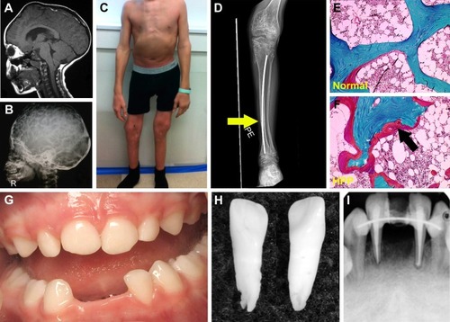 Figure 2 Skeletal and dental defects associated with hypophosphatasia.
