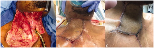 Figure 2. Case 1. (A) Extensive thoraco-cervico-facial soft tissue defect and great vessel exposure following multiple debridements. (B) Immediate postoperative appearance following reconstruction with an anterolateral thigh free flap. (C) Patient appearance at follow-up.
