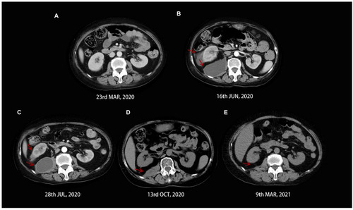 Figure 6 Whole-abdominal CT contrast: dynamic changes of space occupying lesion in the right kidney and right abdominal encapsulated effusion. (A) enhanced abdominal CT: no abnormal presentation. (B) enhanced abdominal CT: new-found right abdominal encapsulated effusion and space-occupying lesion in the right kidney. (C) enhanced abdominal CT: a significant reduction in the size of lesions. (D and E) abdominal CT at follow-ups: no relapse of the lesions.