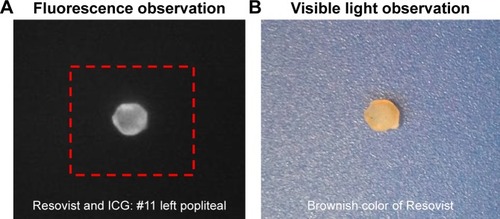 Figure 2 (A) Fluorescence and (B) visible observation of the excised popliteal node in the experiment with Resovist+ICG.Abbreviation: ICG, indocyanine green.