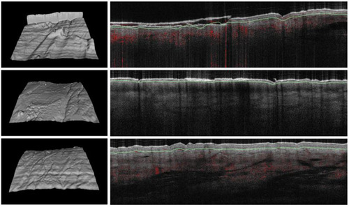 Figure 3 Series of optical coherence tomography (OCT) skin images of a treated subject at baseline (images on the top), at week 2 (images on the middle) and at week 4 (images on the bottom). On the left: Surfaces skin roughness evaluation of three-dimensional constructed OCT images showing progressive improvement of roughness. On the right: OCT images of skin layers showing relevant improvement (reduction of hyperkeratosis, disappearance of scale) in epidermis organization after treatment in comparison with baseline.