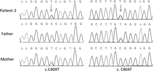Figure 3. Results of sequencing for the c.409C > T and c.904C > T mutations in ATP6V1B1 gene in family-2.