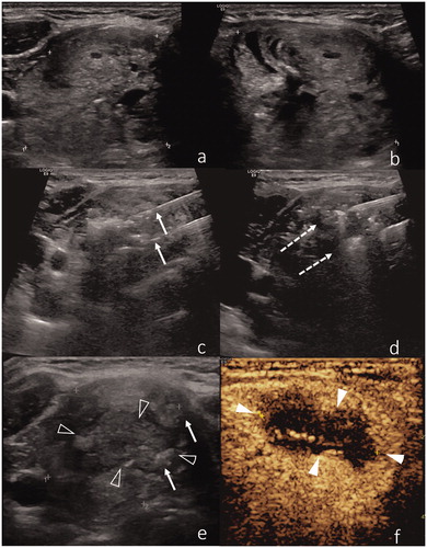 Figure 2. (a,b) US representation of a benign thyroid nodule. (b) Two laser applicators have been introduced within the nodule, with a distance of ∼5 mm between the needle tips (arrows). (c,d) Two needles are introduced in the nodule and gently moved during the procedure according to the pull-back technique (dotted arrows). (e) Air bubbles (arrows) within the ablated nodule (black arrowheads). (f) Post-procedural CEUS confirms lack of contrast enhancement inside the ablated nodule (white arrowheads).