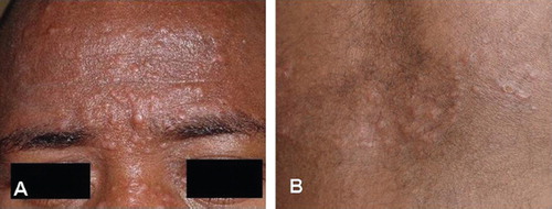 Figure 1. Papulo-nodular lesions: A. On the face; B. On the anterior aspect of the thorax.