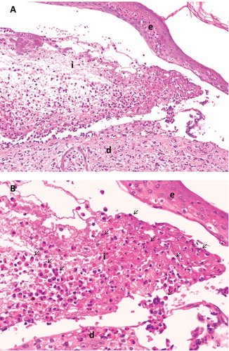 Figure 2. Lesional histolopathology in bullous pemphigoid. 20x magnification (A). 40x magnification (B). e, epidermis; d, dermis; i, inflammatory infiltrate with lymphocytes and numerous eosinophils (arrows).