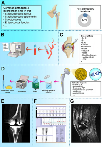 Figure 1 Diagnosis and epidemiology of Periprosthetic joint infection (PJI). (A) Epidemiology of PJI. (B) Molecular biology and Pathogen diagnosis process in PJI. (C) Serologic Testing of PJI. (D) Joint Aspiration and Synovial Fluid Analysis. (E–G) CT/ Bone Scintigraphy/MRI image of PJI patient.