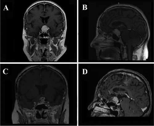 Figure 4. Case 4. Preoperative coronal (A) and sagittal (B) contrast-enhanced T1-weighted MR images showing a large midline TSM adherent to the brain structures and with mainly suprasellar extension. Postoperative coronal (C) and sagittal (D) contrast-enhanced T1-weighted MR images showing STR of the TSM.