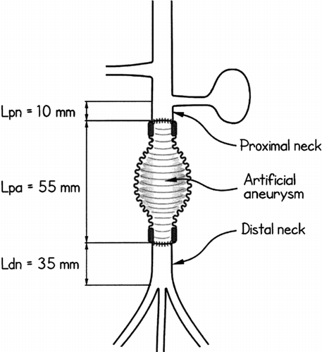 Figure 6 Ideal morphological measures of the site of operation: diameter of the infra-renal aorta and lengths of the proximal neck, the artificial aneurysm and the distal neck.