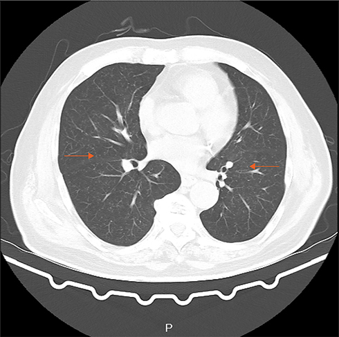 Figure 1 Chest CT showing: diffusely distributed nodules in both lungs, bilateral bronchiolitis, and tuberculosis could not be excluded. The aortic arch was thickened, and the local calcified plaque moved inward, which indicated further aortic CTA examination.