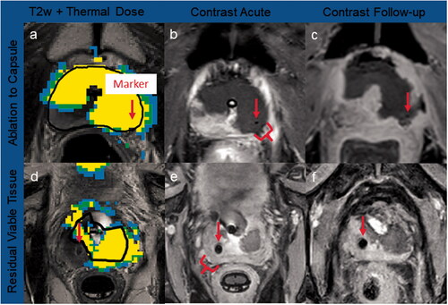 Figure 5. Case examples of thermal dose and contrast-enhanced imaging. Marker centers are shown with red arrows. Ablation to capsule: a gold marker located did not impact ultrasound heating, with thermal dose (a) accumulating to the prostate capsule, and no residual tissue post-TULSA confirmed on acute (b) and 3-month CE imaging (c). Residual viable tissue: significant amounts of prostate tissue were left outside treatment field due to thermometry contamination from the nitinol artifact, leading to extensive undershoot behind the marker (d), confirmed on acute (e) and 8-day CE imaging (f).