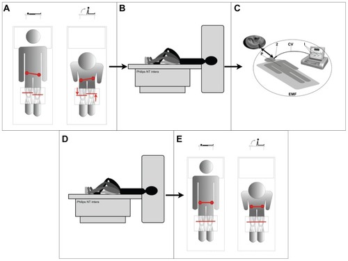 Figure 1 Study design overview. (A) Initial assessment of functional dysmetria (FD). (B) Pre radio-electric asymmetric conveyer neuro-postural optimization (REAC-NPO) scans during performance of the motor task. (C) Administration of REAC-NPO. (D) Post REAC-NPO scans during performance of the motor task. (E) Post-REAC-NPO assessment of FD.