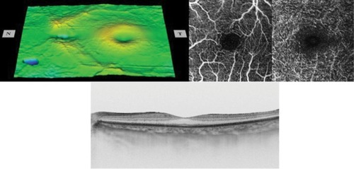 Figure 3 The retinal surface map (top left), optical coherence tomography angiography images showing foveal avascular zone in the superficial and deep plexuses (top right), and horizontal cross-sectional swept-source optical coherence tomography image (bottom) of the normal fellow eye.