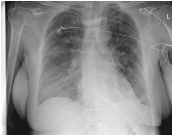 Figure 2. The chest x-ray at intensive care unit admission shows diffuse pulmonary edema consistent with prominent capillary leak, bilateral pleural effusions and the need for high-flow nasal cannula oxygenation.