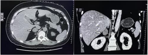 Figure 1 Adrenal contrast-enhanced computed tomography at the patient’s first hospital visit. Arrow indicates adrenal adenoma.