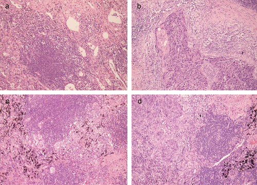 Figure 2. Micrographs of typical tertiary lymphoid structures (TLS) in NSCLC. (a) High-maturation of TLS; (b) low-maturation of TLS; (c) high-expression of TLS; (d) low-expression of TLS.
