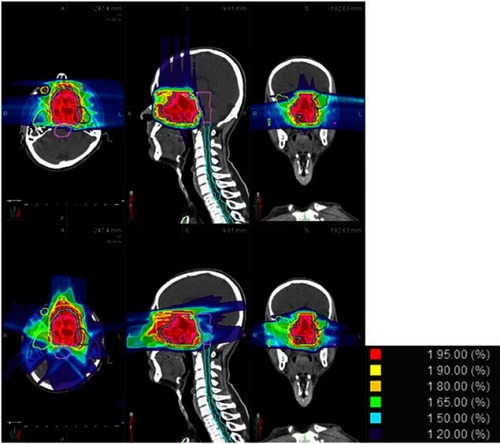 Figure 2 Dose distribution of intensity-modulated carbon-ion-based radiation therapy (IMCT) and intensity-modulated photon-based radiation therapy (IMRT) planning in one patient which demonstrates a typical comparison of the dose distribution by IMCT and IMRT planning in transverse, coronal, and sagittal sections.
