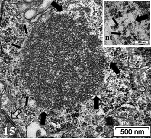 Figure 15. Detailed view of the fibro-particulate aggregate where sticking out filamentous extensions are marked by thick arrows and thin arrows indicate particulate parts. Axo-somatic synapse (open arrow). Insert: Exhibit of the edge of the aggregate somewhat concealed components indicating that threads emerging out of it are from 4–5 nm in thickness (wide arrows) with mRNA – polysome structures (thin arrows); nt: neurotubule